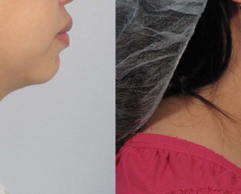 laser neck liposuction nyc