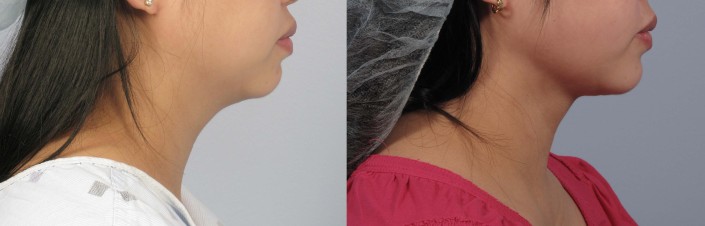 laser neck liposuction nyc