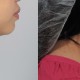 laser neck liposuction nyc