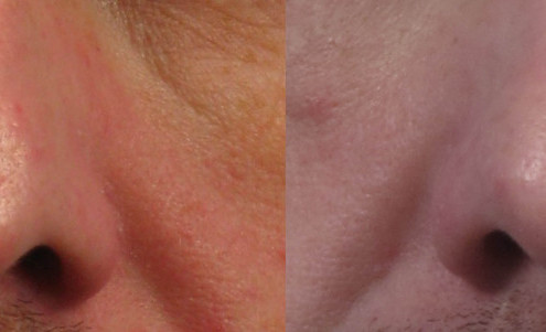 Dr. brett kotlus cosmetic oculoplastic nasal injection scar