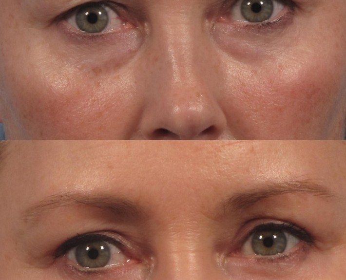 Dr. brett kotlus cosmetic oculoplastic 4-lid blepharoplasty