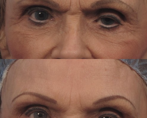 Dr. brett kotlus cosmetic oculoplastic tichophytic brow lift