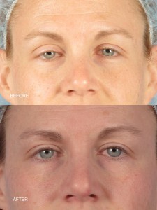 Dr. brett kotlus cosmetic oculoplastic ptosis repair
