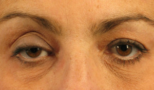 Dr. brett kotlus cosmetic oculoplastic droopy eyelid