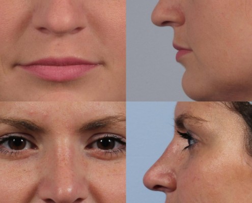 Dr. brett kotlus cosmetic oculoplastic rhinoplasty