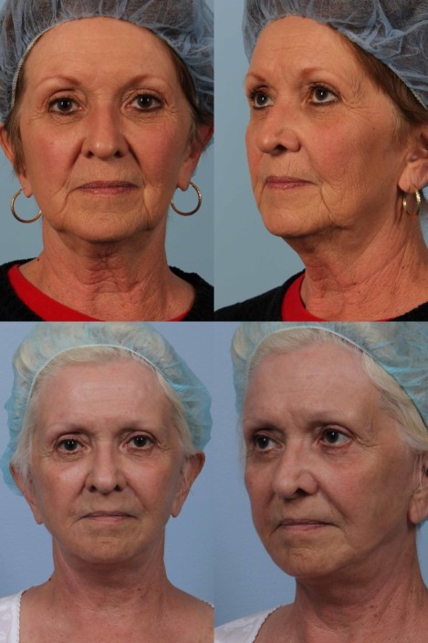 nyc facelift surgery laser