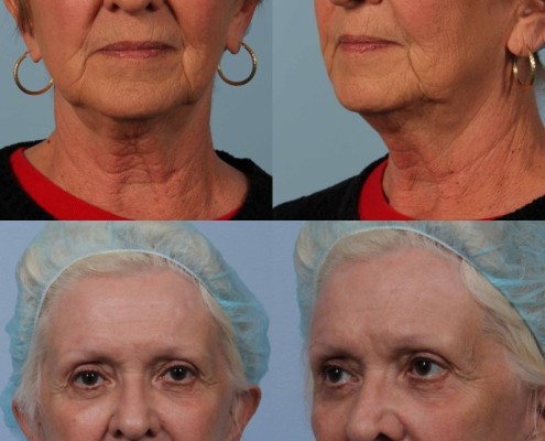 nyc facelift surgery laser