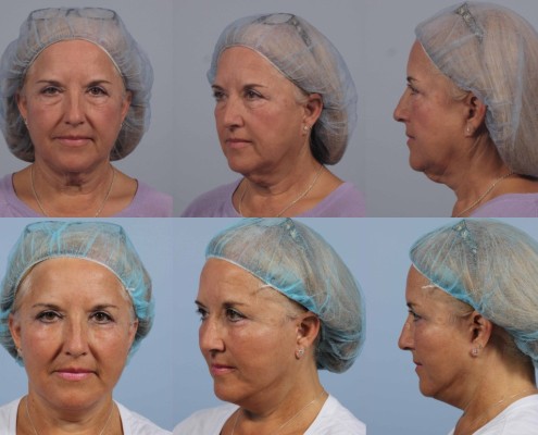 facelift revision nyc