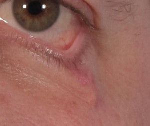 Dr. brett kotlus cosmetic oculoplastic scar retraction