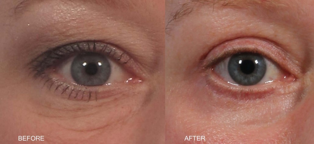 Dr. brett kotlus cosmetic oculoplastic skin pinch blepharoplasty