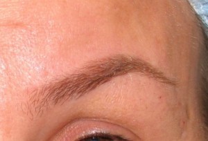 Dr. brett kotlus cosmetic oculoplastic high arch botox