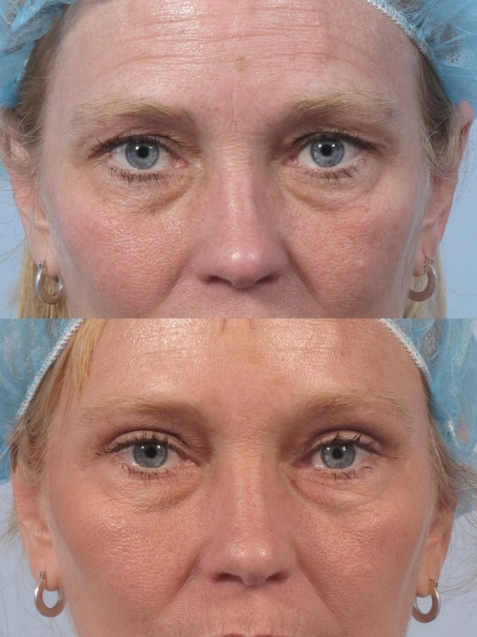 Dr. brett kotlus cosmetic oculoplastic eyelid lift ny