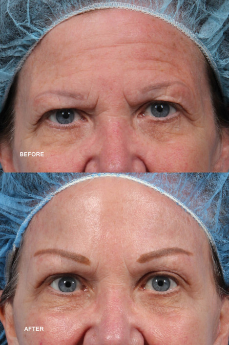 hairline brow lift