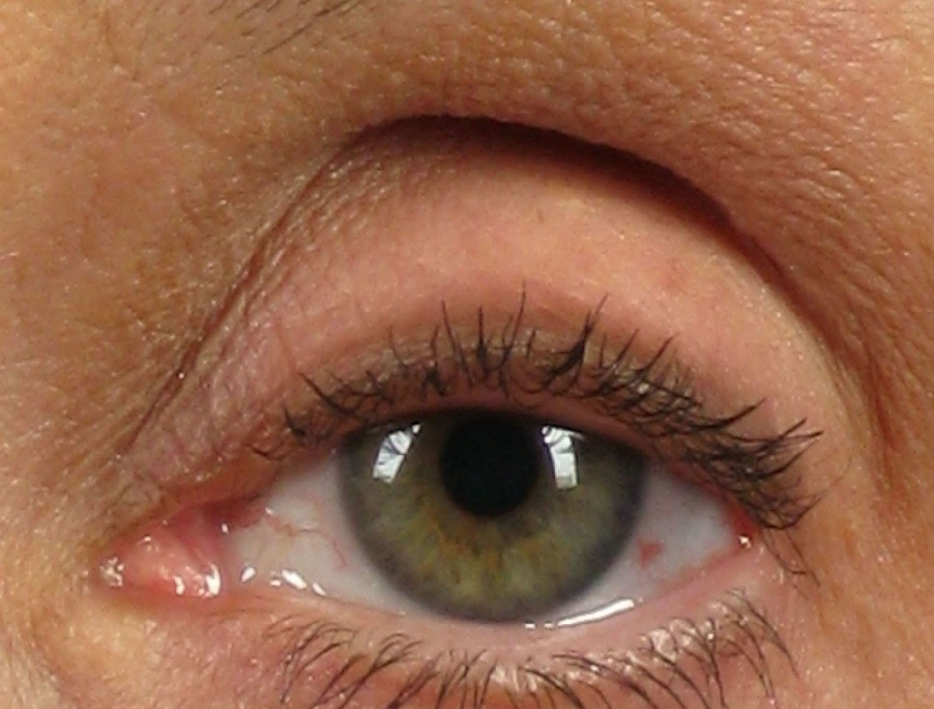 Dr. brett kotlus cosmetic oculoplastic superior sulcus