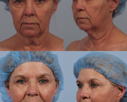 facelift oculoplastic ny