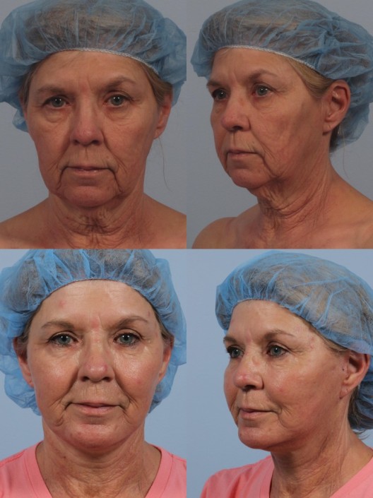 facelift oculoplastic ny