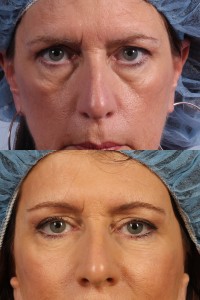 dr. brett kotlus eye bag surgery ny