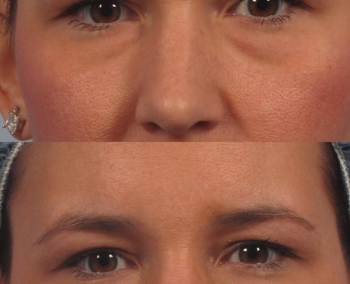 dr. brett kotlus eyelid non-surgical