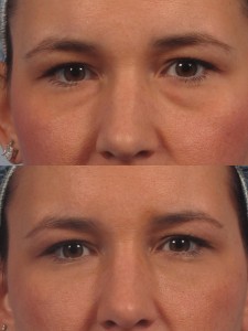 dr. brett kotlus eye bag filler treatment new york