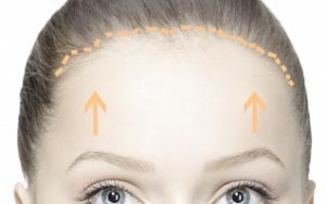 trichophytic-brow-lift-300x188