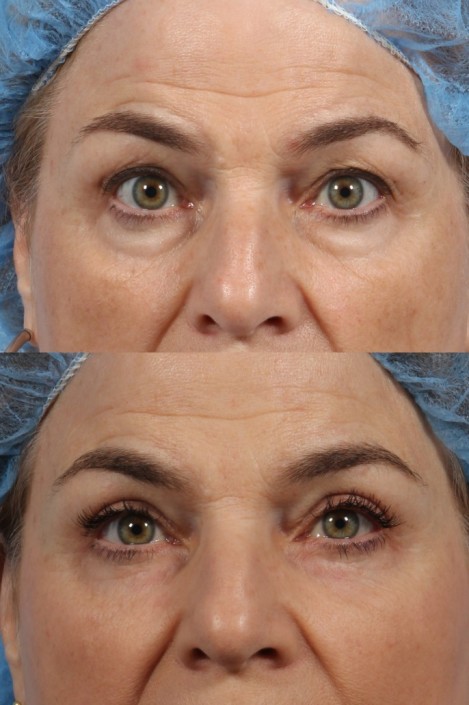 nyc eyelid lift surgery