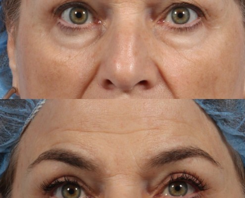 nyc eyelid lift surgery