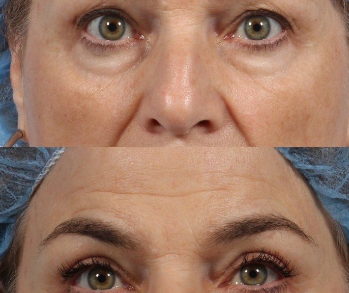 nyc eyelid lift surgery