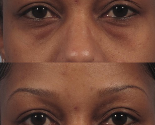 RESIDUAL EYE BAGS AND BLEPHAROPLASTY PROCEDURE