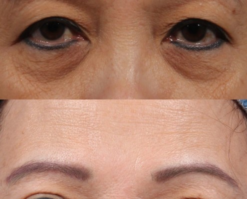 Dr. brett kotlus cosmetic oculoplastic double eyelid lift