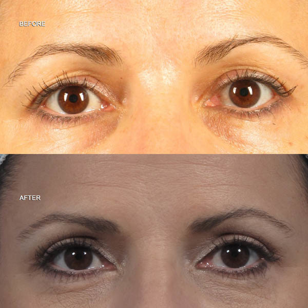 Dr. brett kotlus cosmetic oculoplastic eye surgery