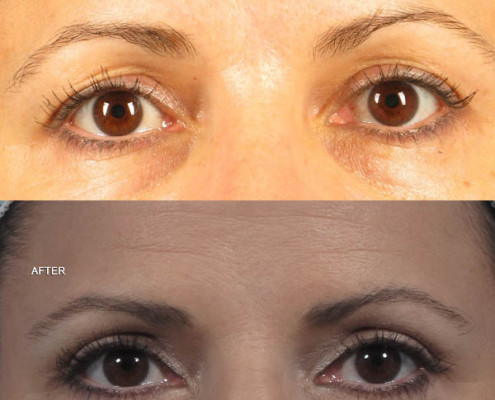 Dr. brett kotlus cosmetic oculoplastic eyelid lift ny