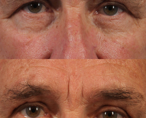 dr. brett kotlus eyebrow younger ny