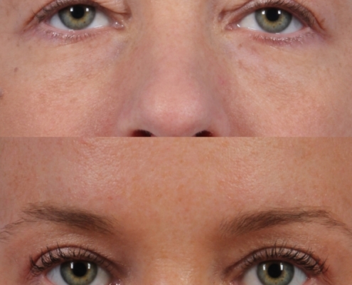 Dr. brett kotlus cosmetic oculoplastic blepharochalasis ny