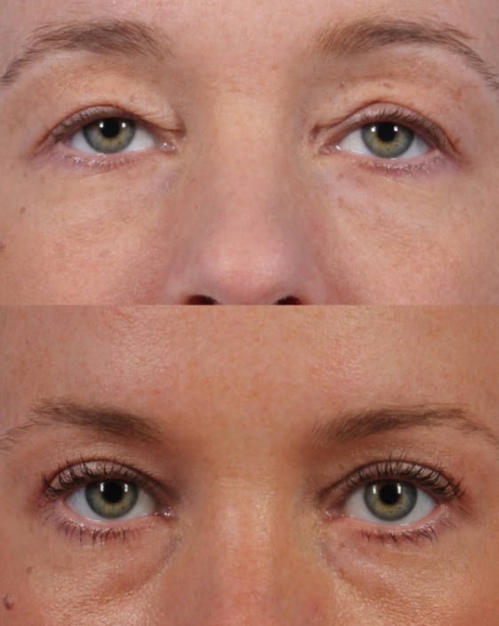 Dr. brett kotlus cosmetic oculoplastic blepharochalasis ny