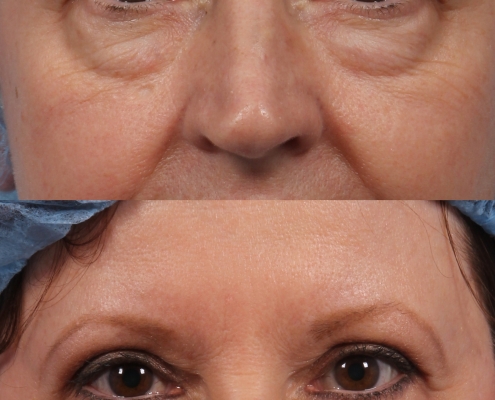 Double Eyelid Tape and Glue  Dr. Brett Kotlus, Cosmetic Oculoplastic  Surgeon, NYC