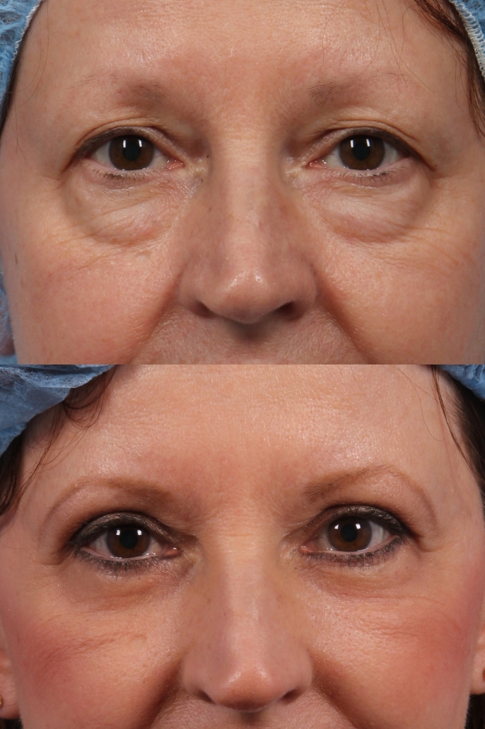 Blepharoplasty in Colombia Eyelid Surgery  Prices