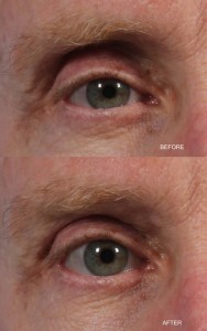 Dr. brett kotlus cosmetic oculoplastic hollow upper lid treatment