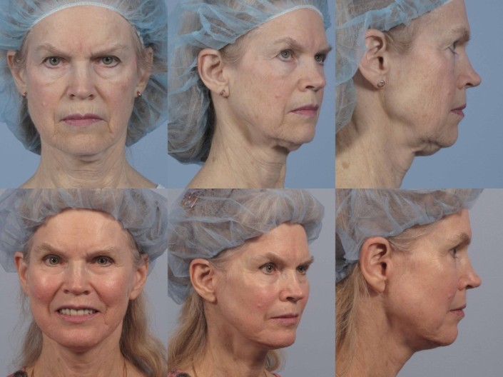 Neck lift nyc fat