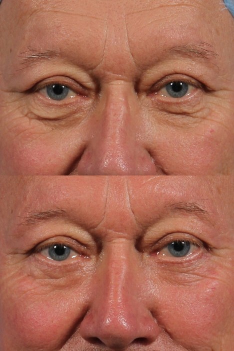 male lower eyelid skin pinch