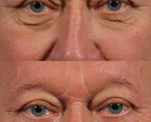 male lower eyelid skin pinch