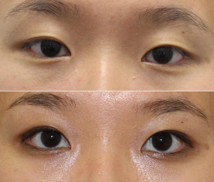 dr. brett kotlus double eyelid surgery