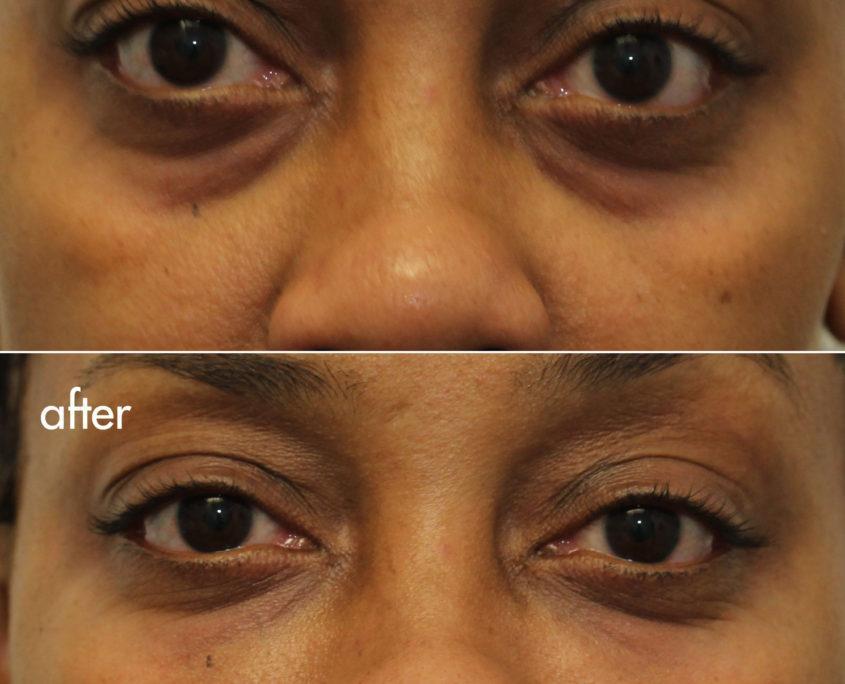 kotlus cannula eye lift