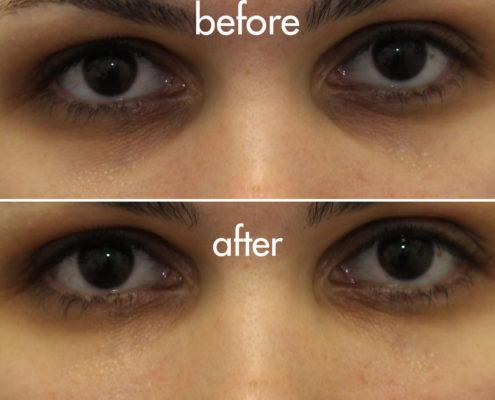 kotlus under eye filler