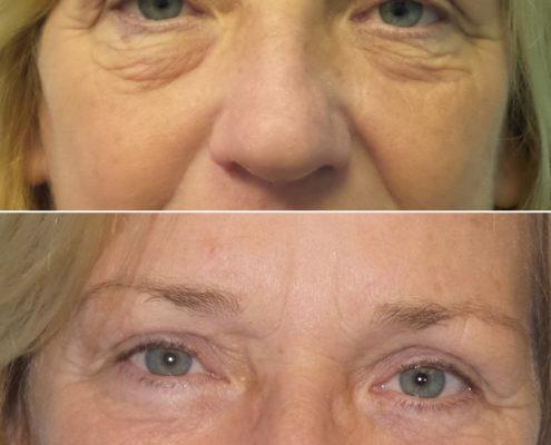 dr. brett kotlus lower blepharoplasty nyc