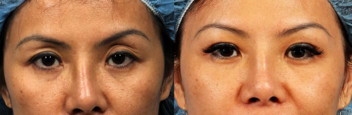 eyelid fat grafting nyc