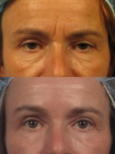 dr. brett kotlus festoon botox filler