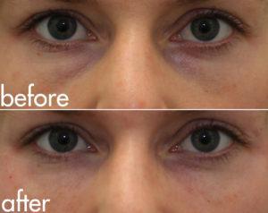 eye bags filler