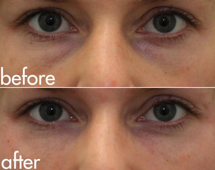 kotlus eye bags filler