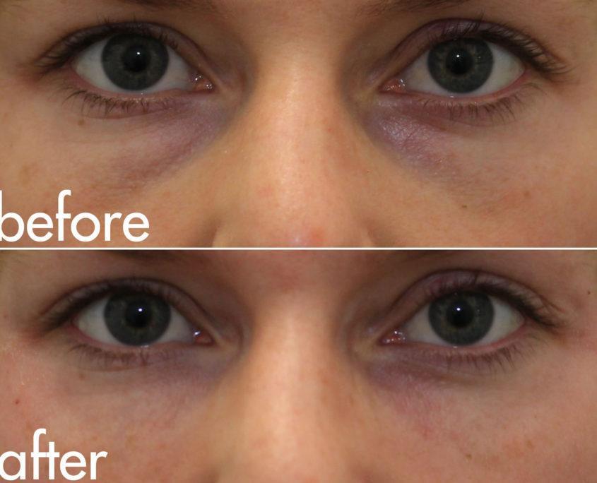 kotlus eye bags filler