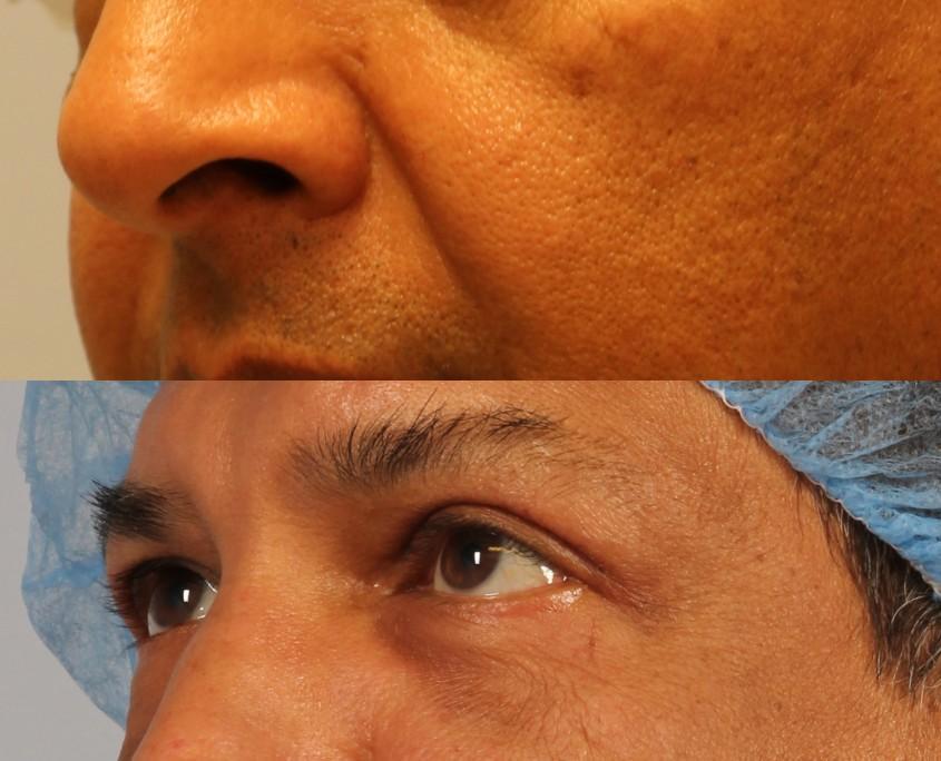 dr. brett kotlus lower eyelid lift man